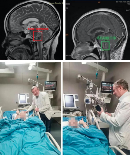 “不定時(shí)炸彈”腦干海綿狀血管瘤成功全切案例合集——INC巴特朗菲教授